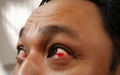 Floorball Augenverletzung